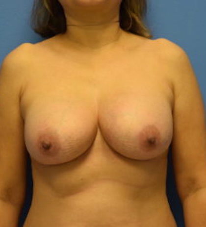 Breast Augmentation Before & After Patient #1119
