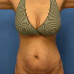 Tummy Tuck Before & After Patient #1128