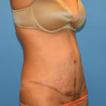 Tummy Tuck Before & After Patient #1128
