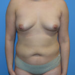 Liposuction Before & After Patient #1135