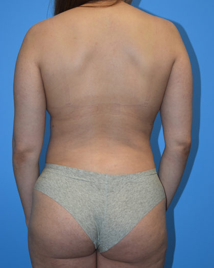 Liposuction Before & After Patient #1135