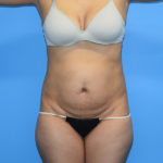 Tummy Tuck Before & After Patient #1142