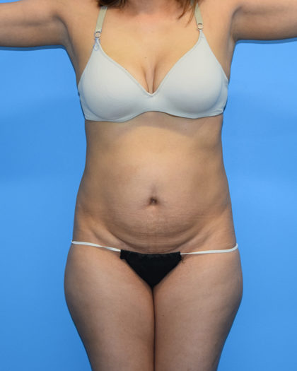 Tummy Tuck Before & After Patient #1142