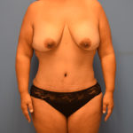 Tummy Tuck Before & After Patient #1147