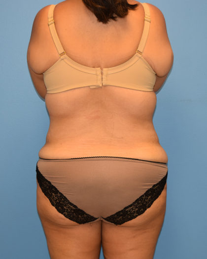 Tummy Tuck Before & After Patient #1147