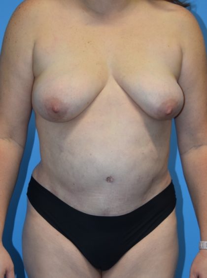 Tummy Tuck Before & After Patient #1178