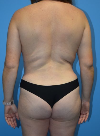 Tummy Tuck Before & After Patient #1178