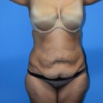 Tummy Tuck Before & After Patient #1189