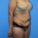 Tummy Tuck Before & After Patient #1189