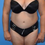 Liposuction Before & After Patient #1196