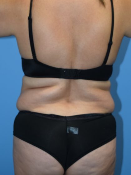 Liposuction Before & After Patient #1196