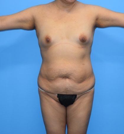 Tummy Tuck Before & After Patient #1254