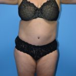 Liposuction Before & After Patient #1268