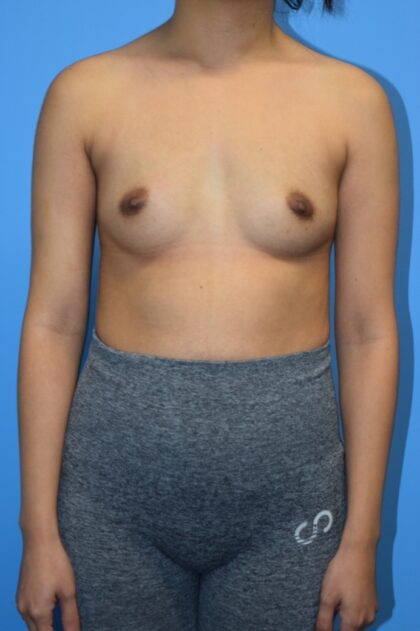 Breast Augmentation Before & After Patient #1492