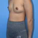 Breast Augmentation Before & After Patient #1492