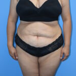 Tummy Tuck Before & After Patient #1483