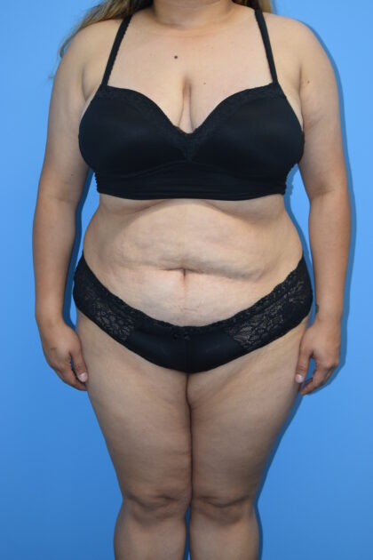Tummy Tuck Before & After Patient #1483