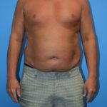 Liposuction Before & After Patient #1273