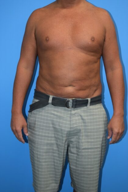 Liposuction Before & After Patient #1273