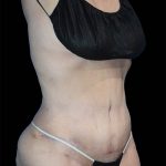 Tummy Tuck Before & After Patient #1690
