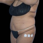 Tummy Tuck Before & After Patient #1691