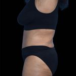 Tummy Tuck Before & After Patient #1691