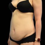 Tummy Tuck Before & After Patient #1689