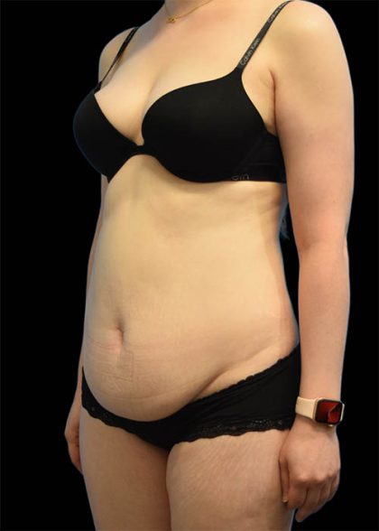 Tummy Tuck Before & After Patient #1689