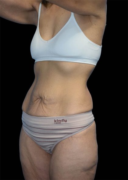 Tummy Tuck Before & After Patient #1692