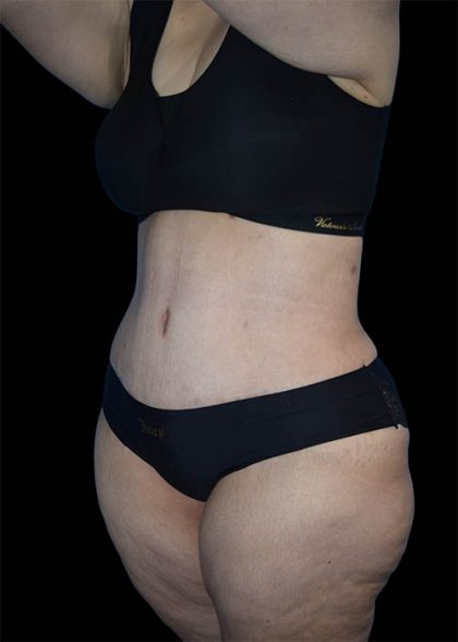Tummy Tuck Before & After Patient #1693
