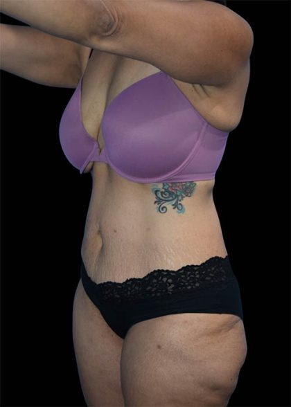 Tummy Tuck Before & After Patient #1694