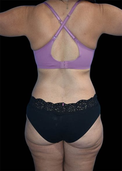 Tummy Tuck Before & After Patient #1694