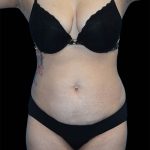 Tummy Tuck Before & After Patient #1695