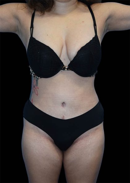 Tummy Tuck Before & After Patient #1695