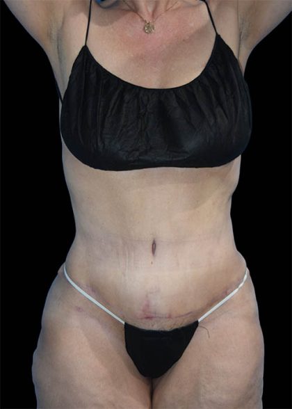 Tummy Tuck Before & After Patient #1690